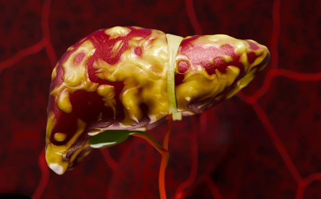 Fatty Liver Can Stay Silent for Years: Here’s What to Watch For fatty liver disease causes symptoms and healthy lifestyle treatment